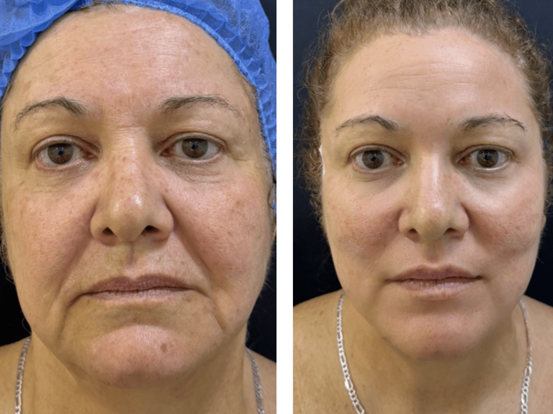 Hialuronico Medellin clinica estética