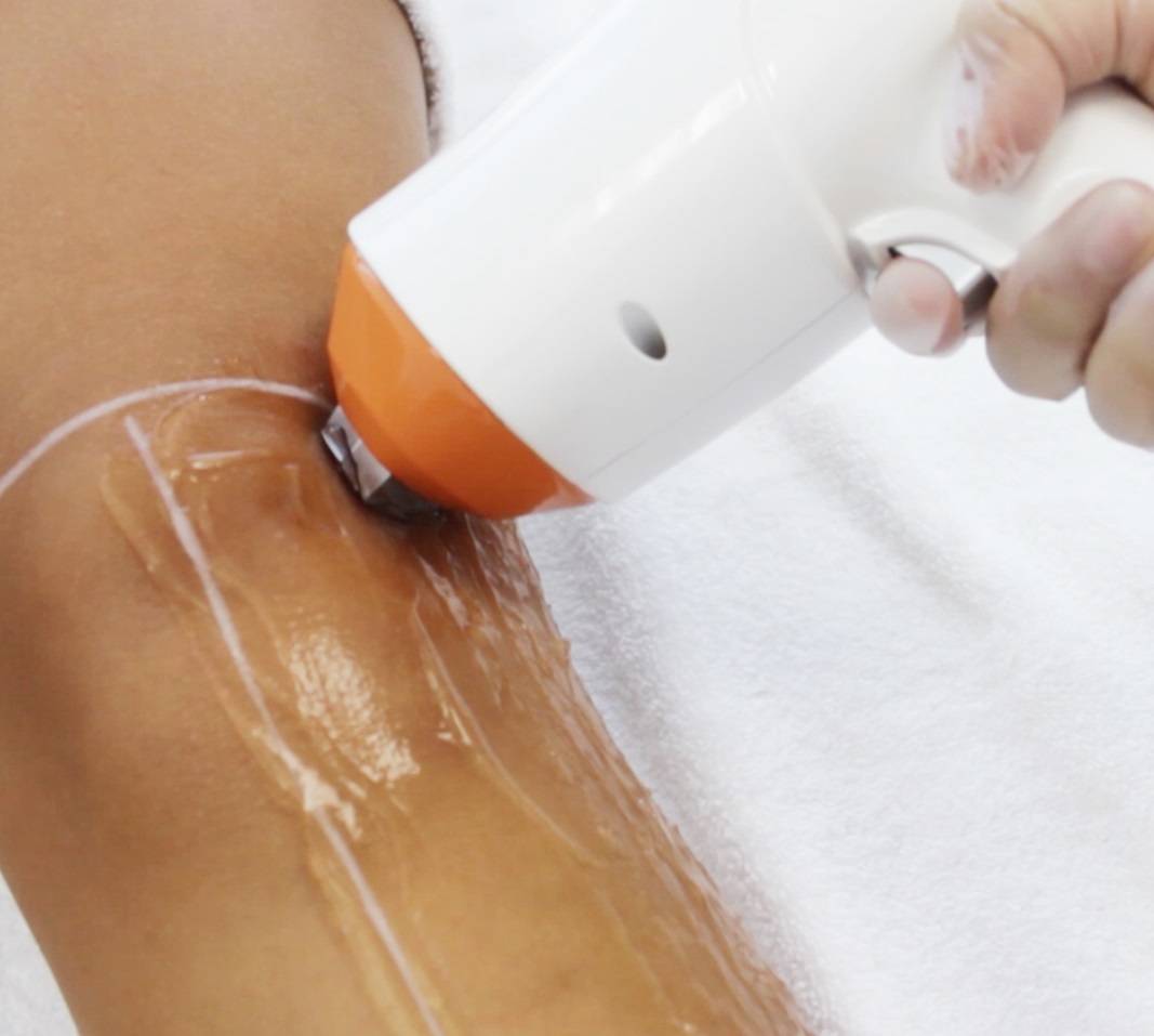 Depilacion-laser-Medellin-Poblado