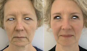 Facial Rejuvenation Medellín before and after