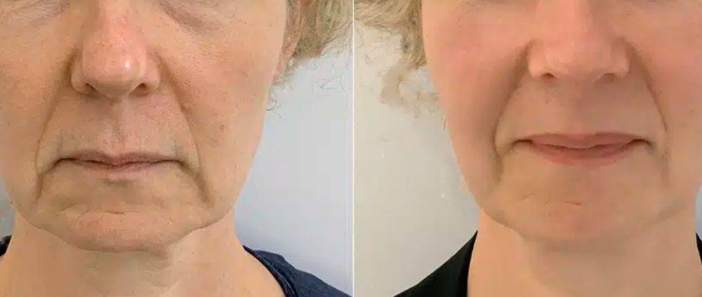 Fillers-Rejuvenecimiento-Facial-Medellin-antes-despues