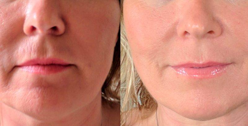 Tratamiento-facial-Medellin