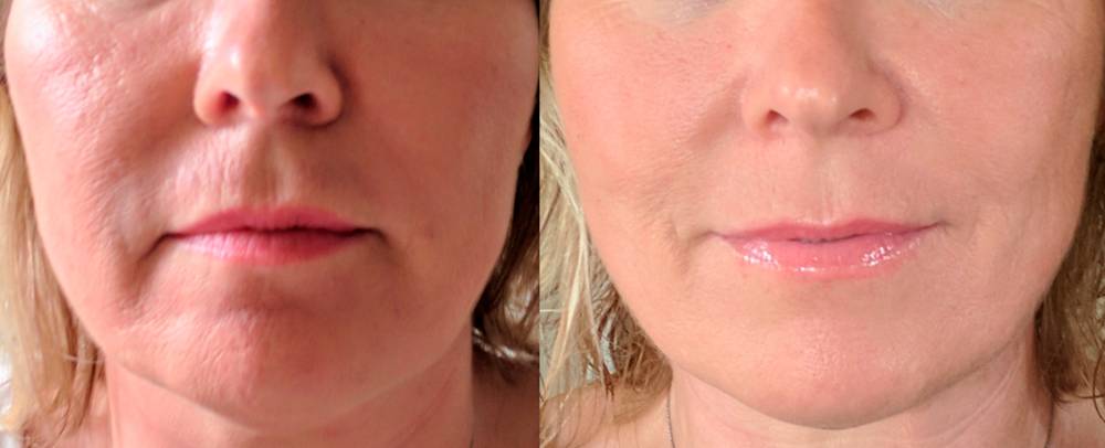 Tratamiento-facial-Medellin