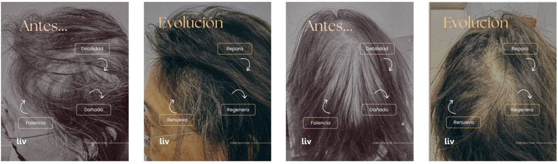 regeneracion-capilar-con-celulas-madre